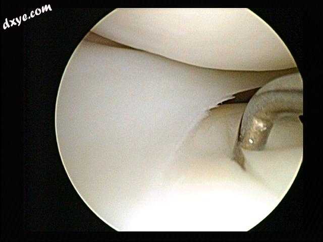 Lateral meniscus located between thigh bone (femur, above) and shin bone (tibia,.jpg