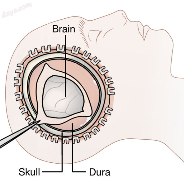 Diagram showing the elements of a 去骨瓣减压术.png