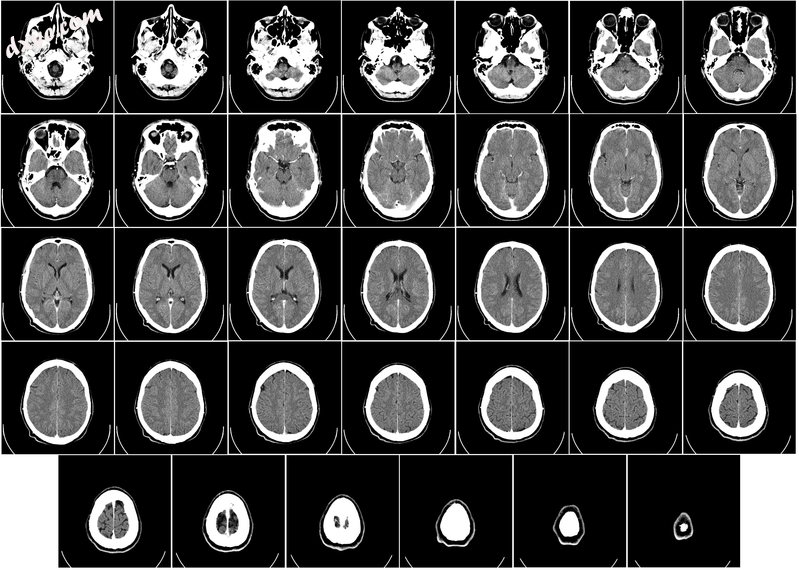 Computer tomography of human brain, from 颅底 to top. Taken with in.png