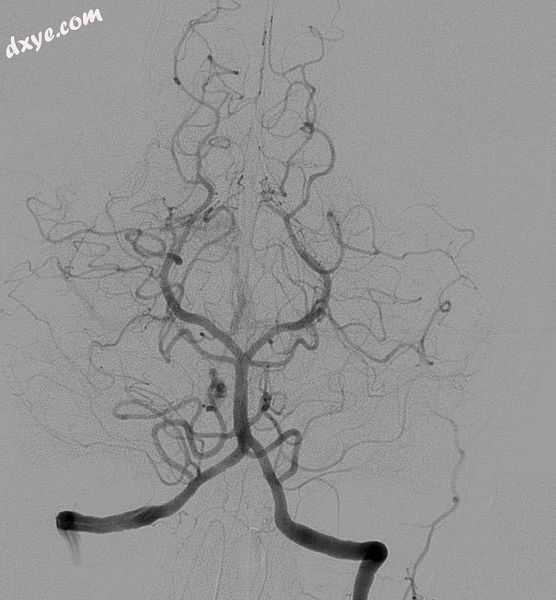 Cerebral angiogram showing a transverse projection of the vertebrobasilar and po.jpg