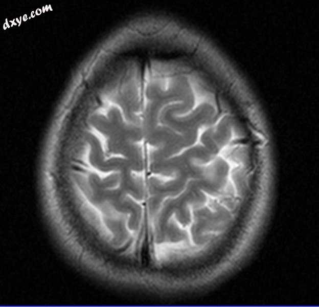 MRI image of the surface of the brain..jpg