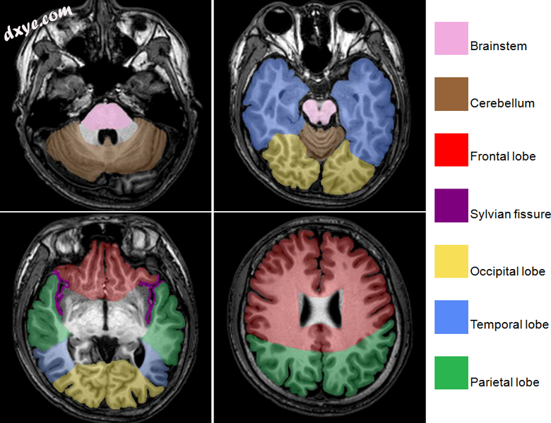 Brain regions on T1 MRI.png