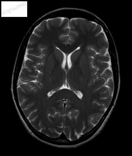 Normal axial T2-weighted MR image of the brain..png