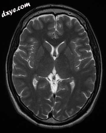 This axial T2-weighted (CSF white) MR scan shows a normal brain at the level of .jpg