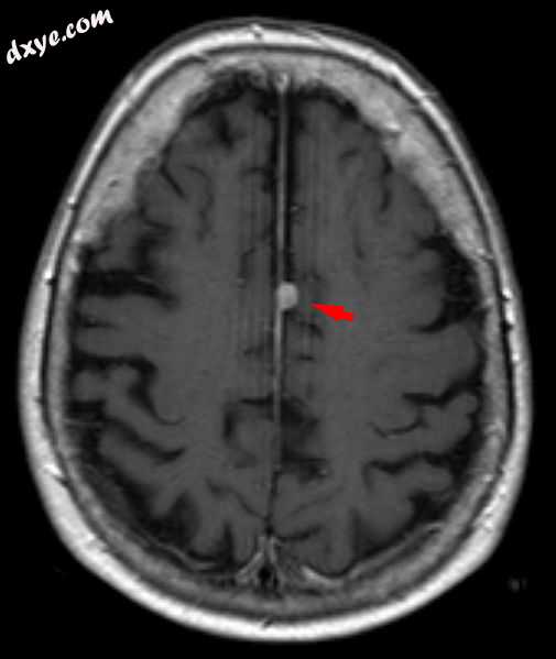 T1 (note CSF is dark) with contrast (arrow pointing to meningioma of the falx).jpg