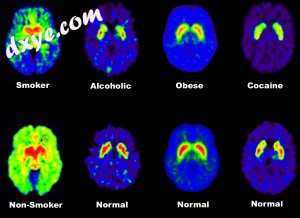 Images obtained with PET (axial sections) that show the effects of chronic drug .jpg