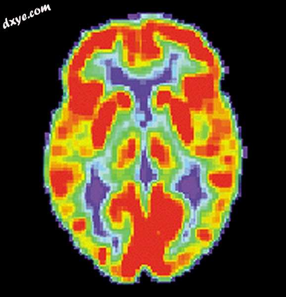 PET scan of a normal brain.jpg