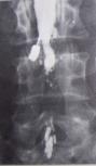 Myelogram showing arachnoiditis in the lumbar spine..jpg
