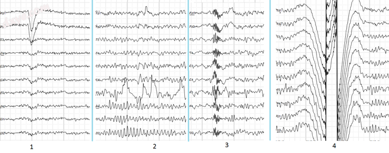 Common artifacts in human EEG. 1  Electrooculographic artifact caused by the exc.png