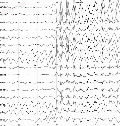 Epileptic spike and wave discharges monitored with EEG.png