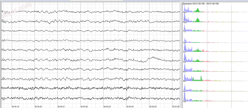 Human EEG with in resting state. Left EEG traces (horizontal – time in seconds;.png