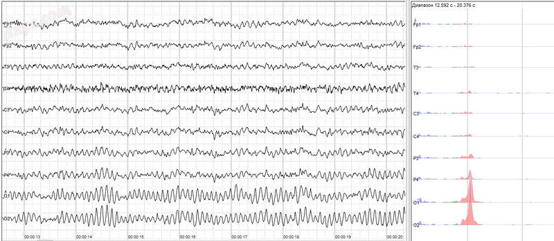 Human EEG with prominent resting state activity – alpha-rhythm. Left.png