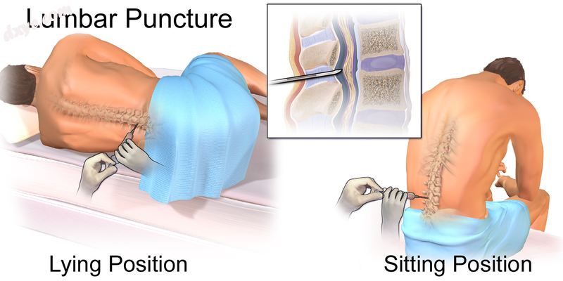 Illustration depicting common positions for lumbar puncture procedure..png