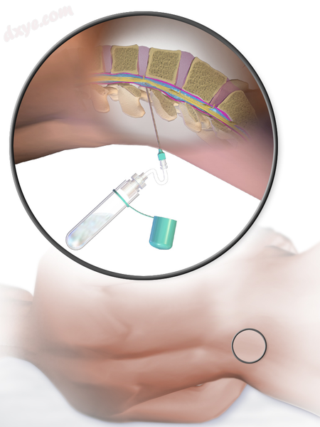 Illustration depicting lumbar puncture (spinal tap).png