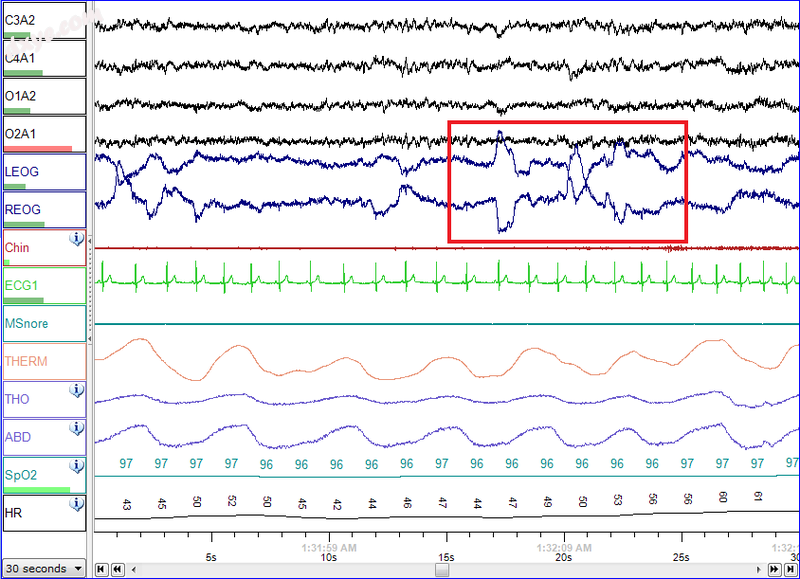 Polysomnographic record of REM sleep. Eye movements highlighted by red rectangle..png