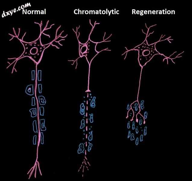 This drawing compares a normal neuron to one undergoing chromatolysis after axon.jpg