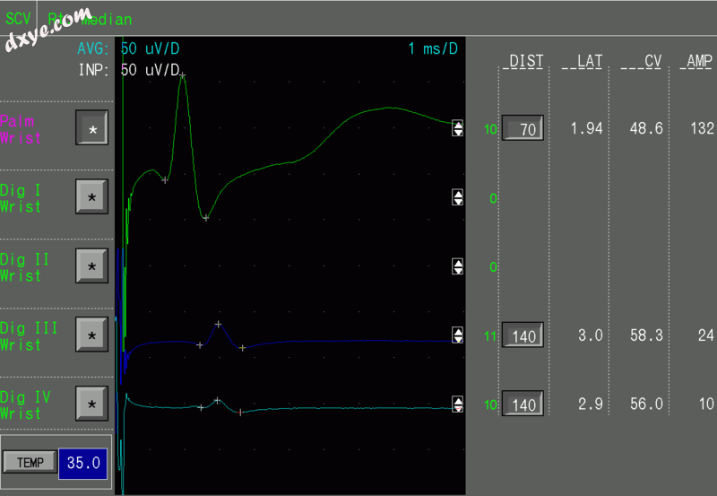 Sensory NCS An example screenshot showing the 结果 of a sensory nerve conduct.png