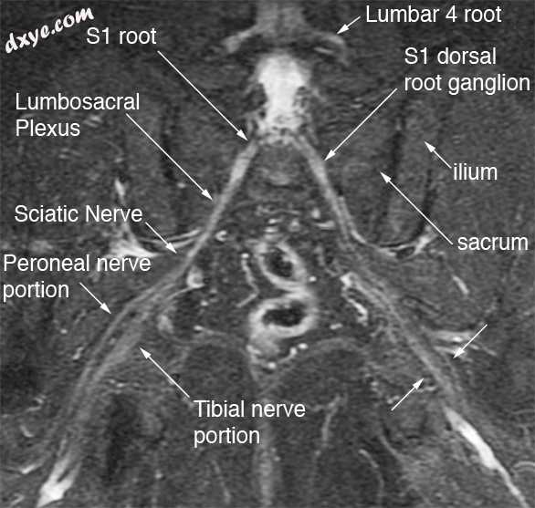 Bilateral Split Sciatic Nerve.jpg
