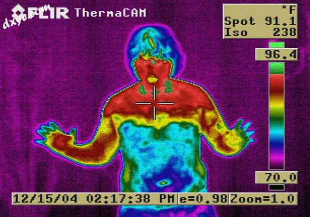 A thermal image of an ETS patient 2 years after surgery, showing corposcindosis .jpg