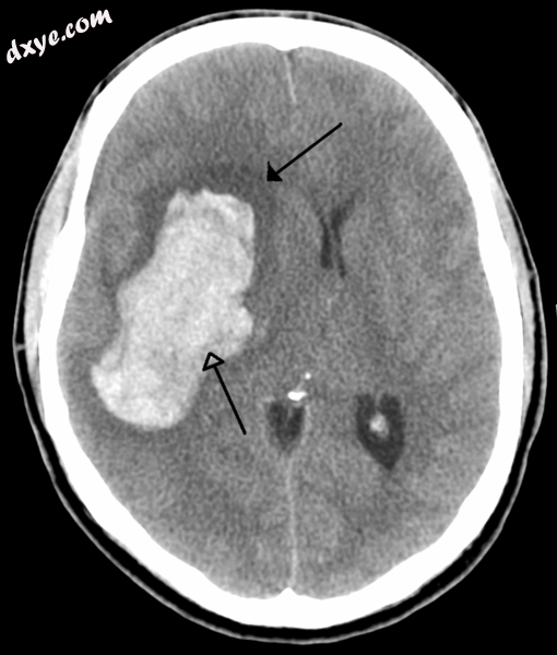 CT scan of a cerebral hemorrhage, showing an intraparenchymal bleed (bottom arro.png