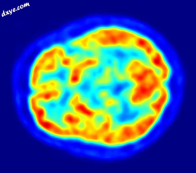 PET image of the human brain showing energy consumption.jpg