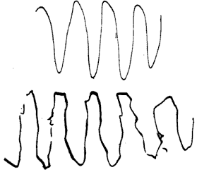 The lower trace shows an attempt by a patient with cerebellar disease to reprodu.png