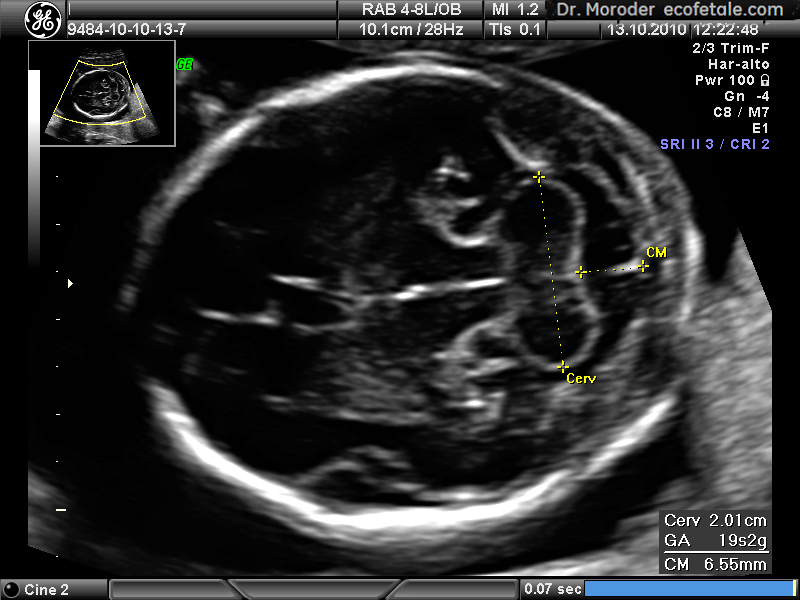 Ultrasound image of the fetal head at 19 weeks of pregnancy in a modified axial .jpg