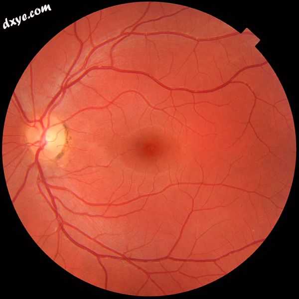 A fundus photograph showing the back of the retina. The white circle is the begi.jpg