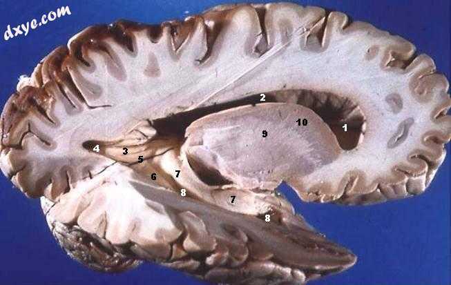 Human brain right dissected lateral view, showing grey matter (the darker outer .jpg