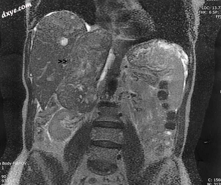 Leiomyosarcoma of the adrenal vein. Coronal view of abdominal MRI. Tumor (arrow).jpg