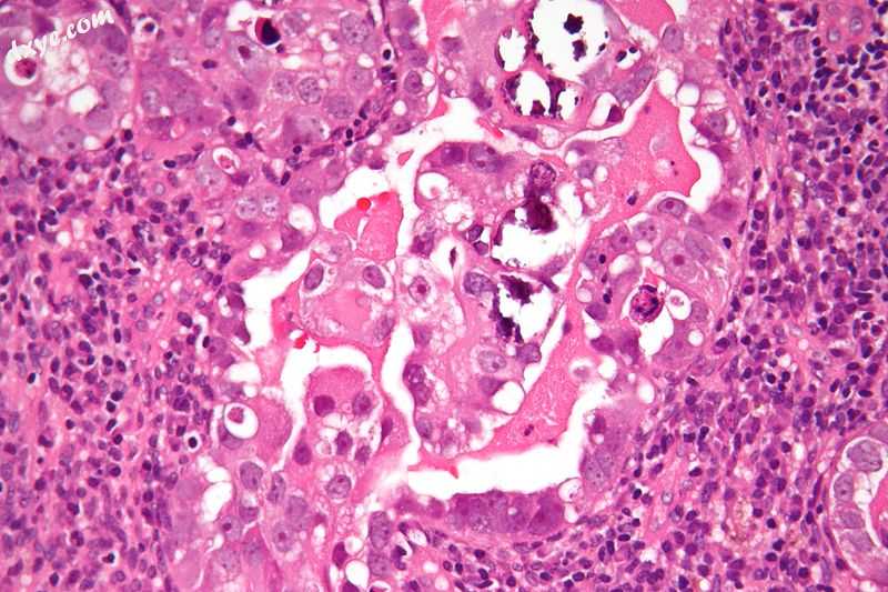 Micrograph of uterine serous carcinoma demonstrating characteristic psammoma bod.jpg