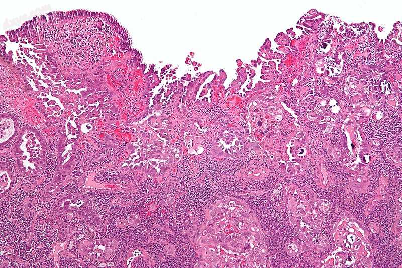 Micrograph of uterine serous papillary carcinoma. H&amp;E stain..jpg