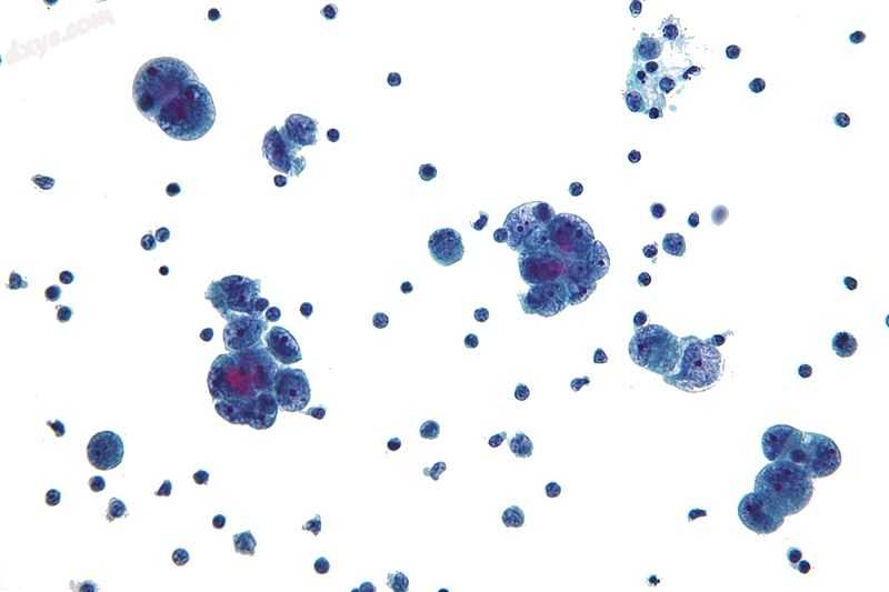Micrograph showing (malignant) peritoneal cytopathology (serous carcinoma), indi.jpg