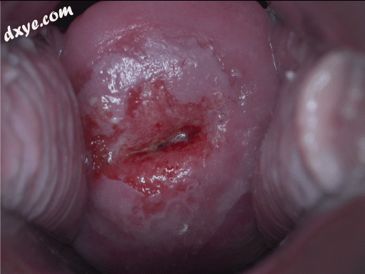 Positive visual inspection with acetic acid of the cervix for CIN-1.gif