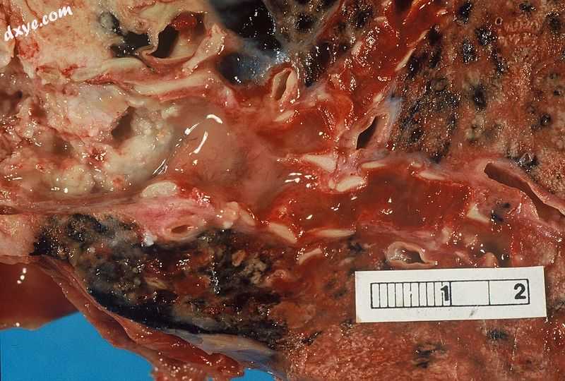 Photograph of a squamous cell carcinoma.jpg