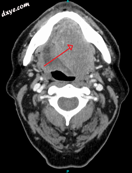 A large head and neck squamous cell carcinoma of the 舌 as seen on CT imaging.png