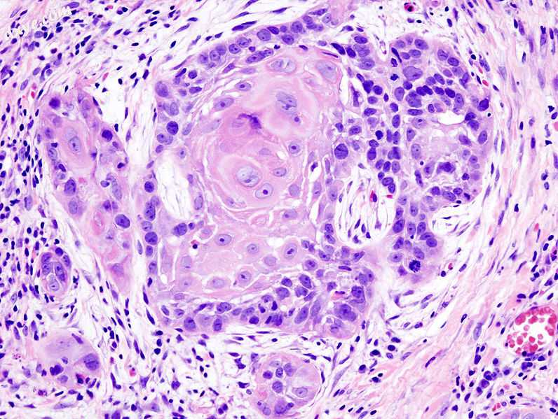 Biopsy of a highly differentiated squamous cell carcinoma of the mouth Haematoxy.jpg