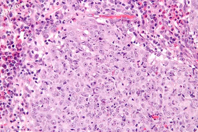 Micrograph of a glassy cell carcinoma of the cervix. H&amp;E stain..jpg