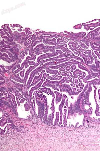 Micrograph of a villoglandular adenocarcinoma the cervix. H&amp;E stain..jpg