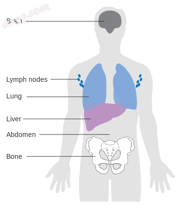 A diagram showing the most common sites for melanoma to spread.png