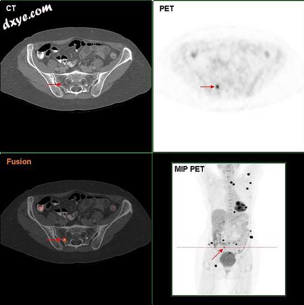 F18-FDG PET CT in a melanoma patient showing multiple lesions, most likely metastases.jpg