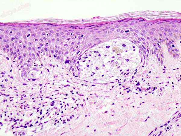 Melanoma in skin biopsy with H&amp;E stain – this case may represent superfic.jpg