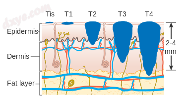 T stages of melanoma.png