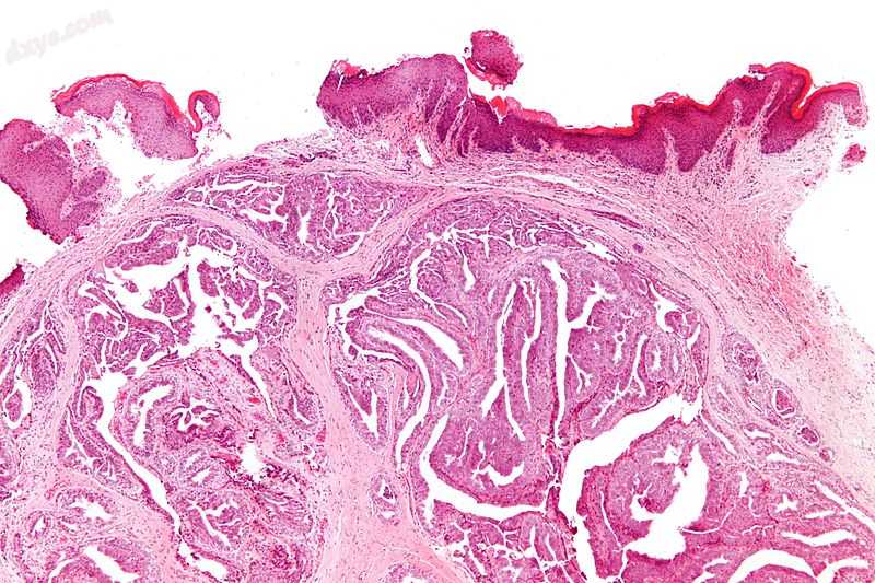 Micrograph of a papillary hidradenoma with the characteristic papillary structur.jpg