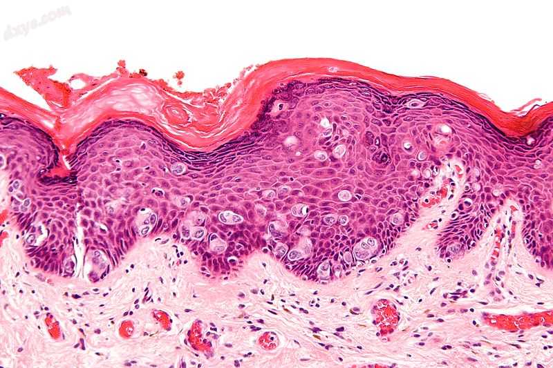 Micrograph of extramammary Paget&#039;s disease, H&amp;E stain.jpg