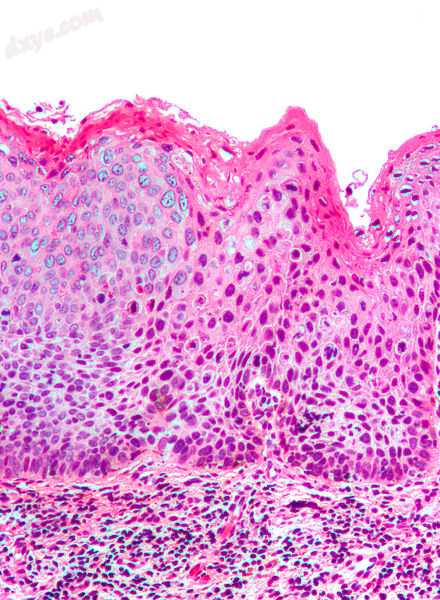 Micrograph of (classic) vulvar intraepithelial neoplasia III. H&amp;E stain..jpg