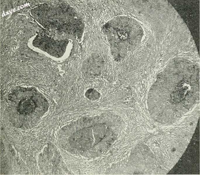 Barthlin carcinoma tissue cross section.jpg