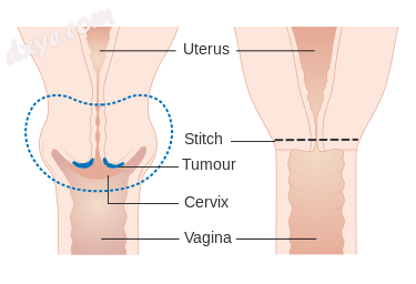 Diagram showing the parts removed with a trachelectomy.png