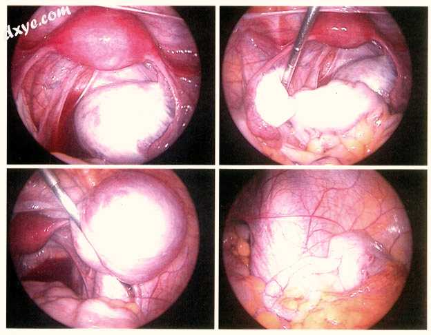 Endometriosis as seen during laparoscopic surgery.jpg