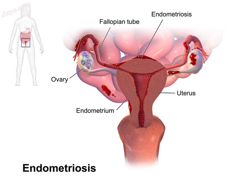 Drawing showing endometriosis.png